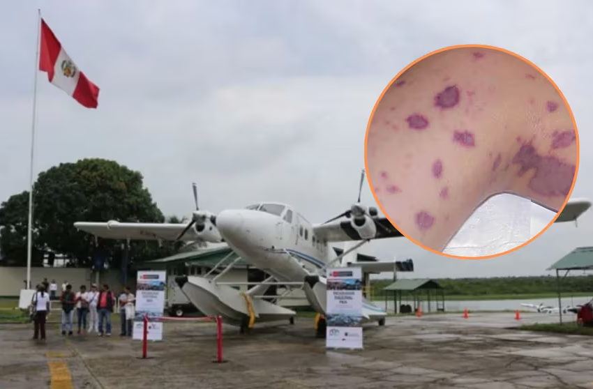  IQUITOS: Alerta de salud por meningitis suspende vuelos en Putumayo