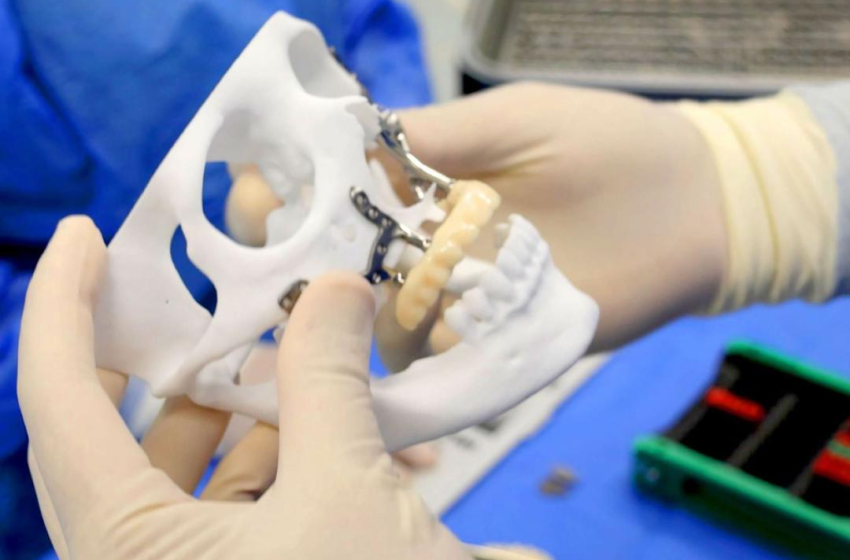  Perú realiza su primera reconstrucción maxilofacial con implante 3D